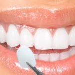 About Dental Veneers