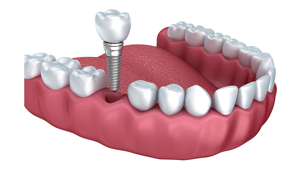 how long does tooth implant surgery take