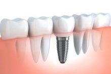 dental implant on the dentition