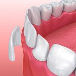More On Dental Porcelain Veneers