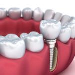 More About Dental Implants