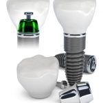 Dental Implants Staten Island: why they need to be placed?