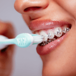 Braces Staten Island: How to look after teeth while wearing them